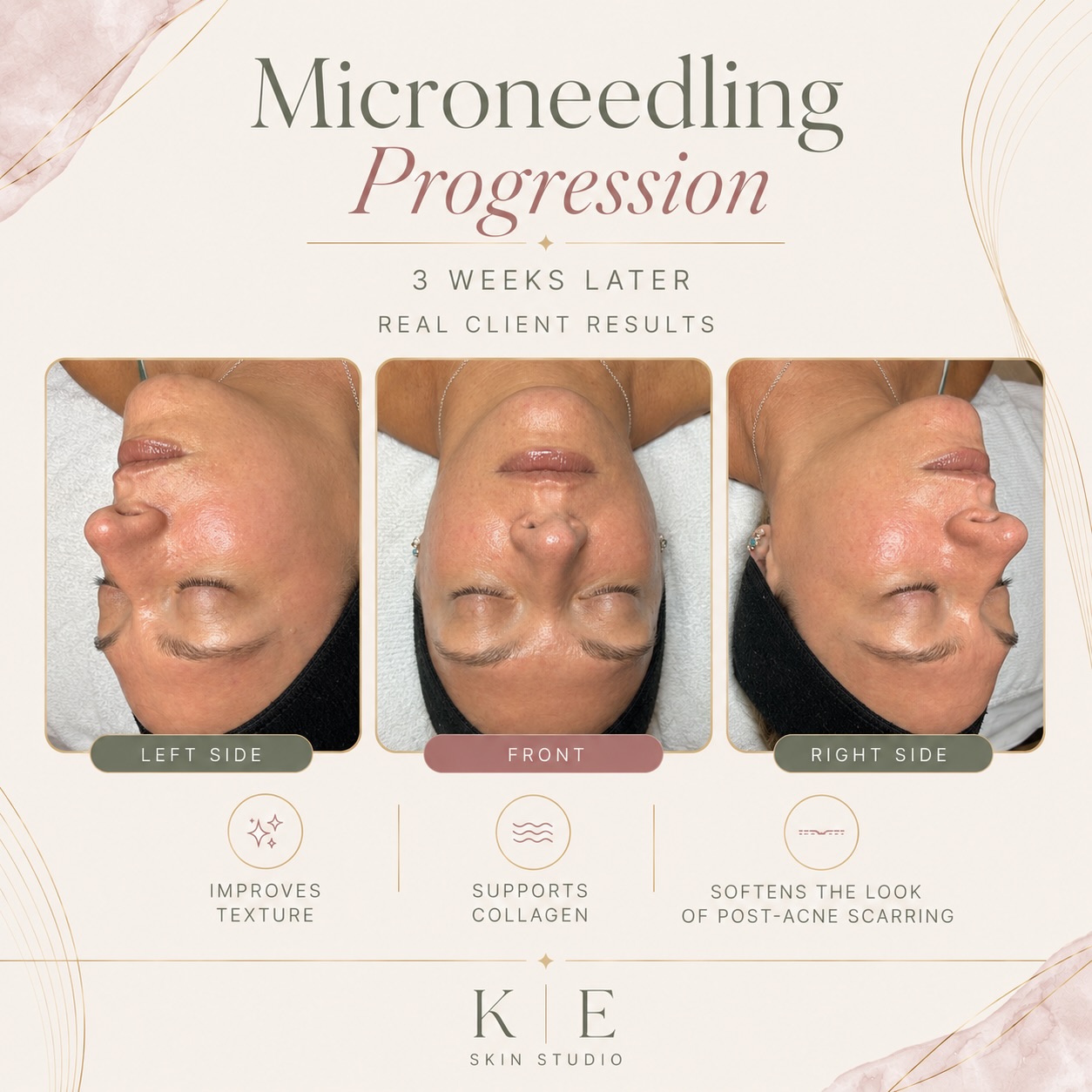 Microneedling treatment